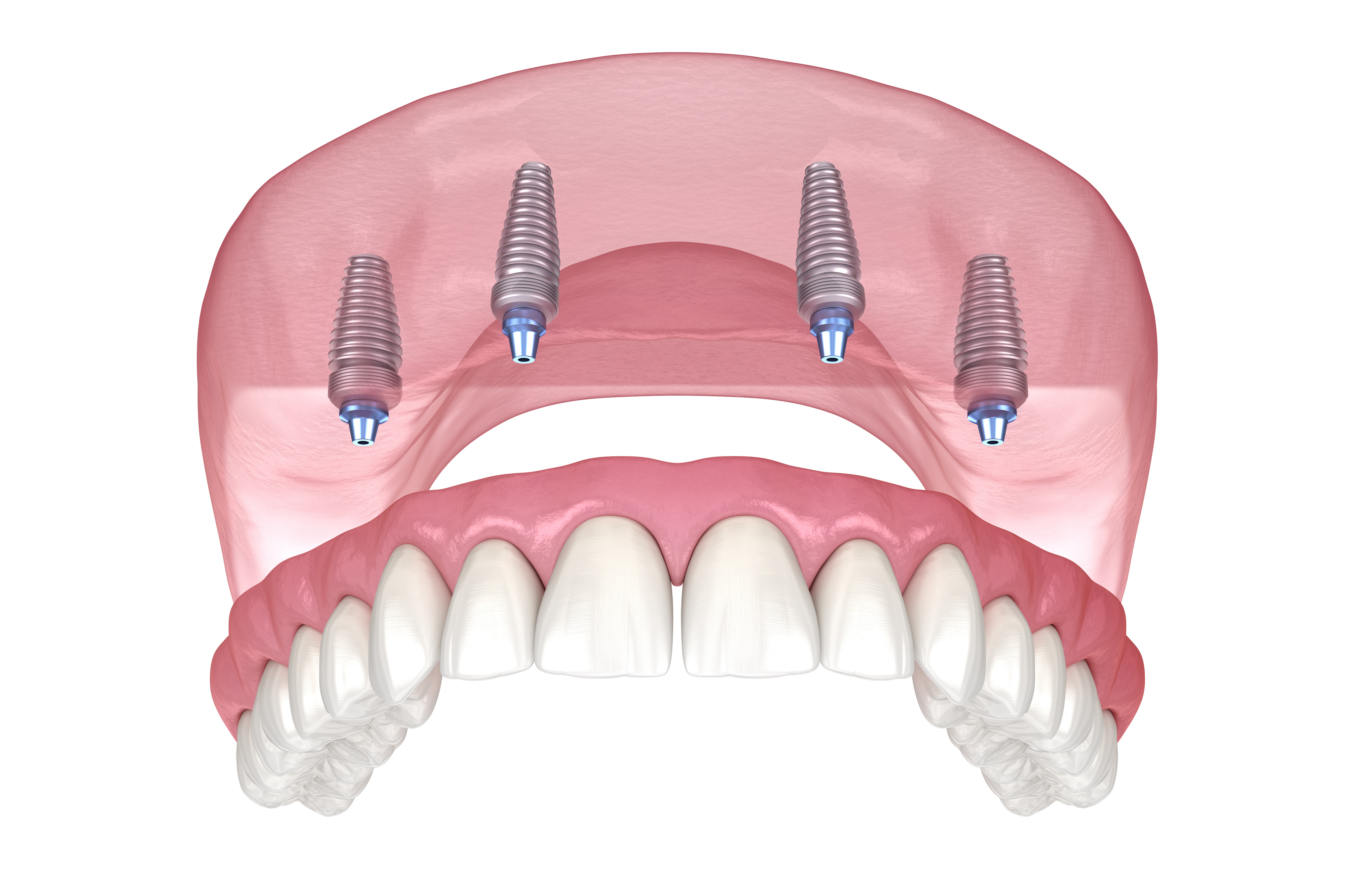 implant dentures