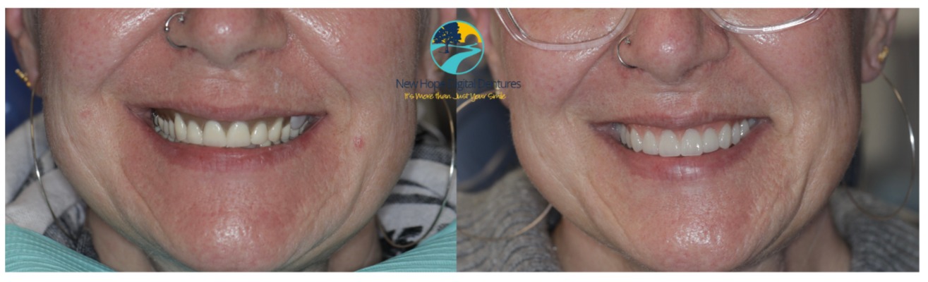Digital Denture before and after photo