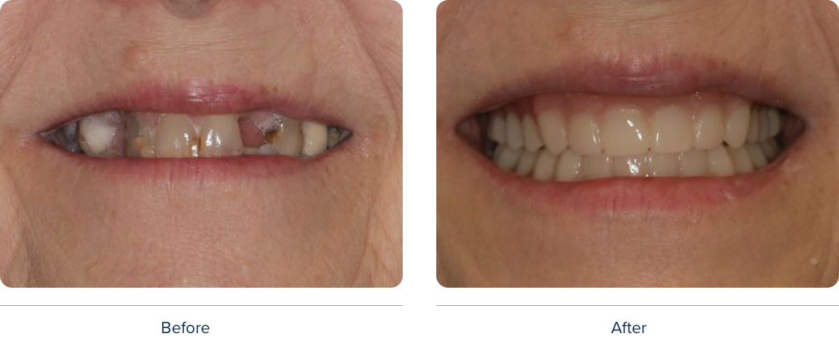 Digital Denture before and after photo