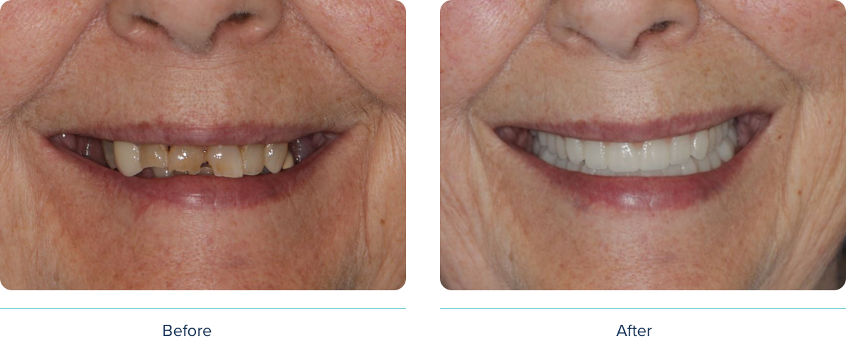 Digital Denture before and after photo