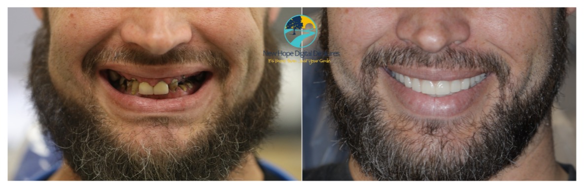 Digital Denture before and after photo