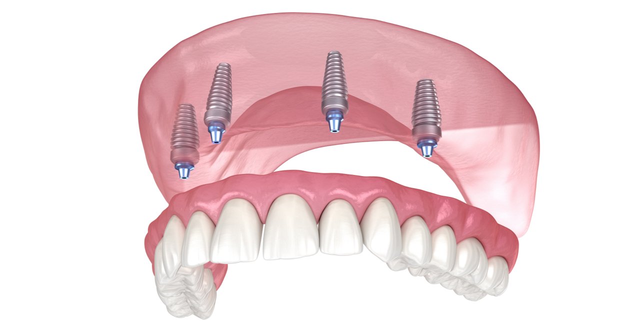 All-On-4 Dentures All-On-4 Dentures