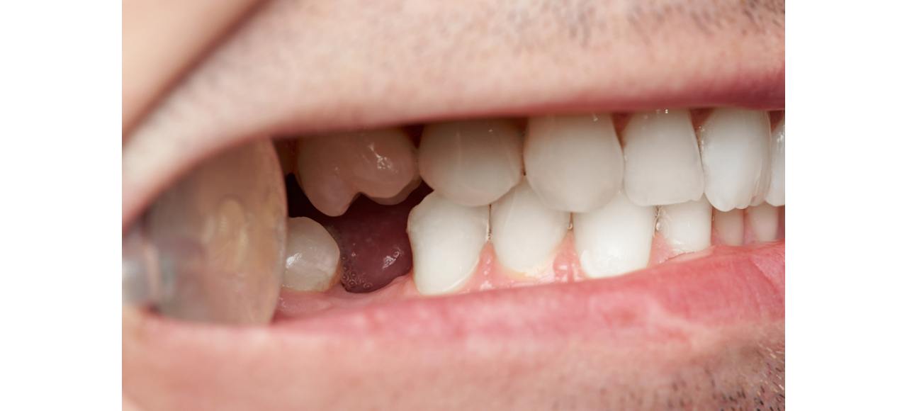 Up-close shot of missing tooth